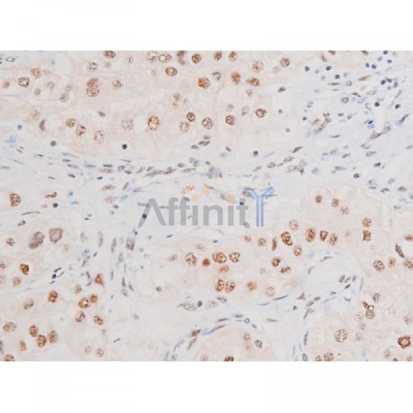 Phospho-NF-kB p65 (Ser281) Antibody - AF3393 at 1/200 staining Human kidney cancer tissue sections by IHC-P.